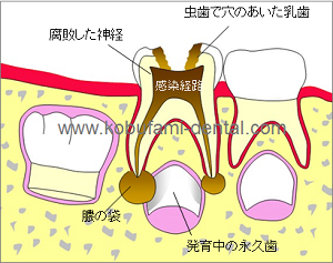 乳歯の虫歯による永久歯の発育不全