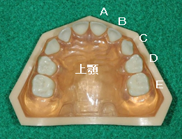 乳歯の虫歯による永久歯の歯並びへの影響